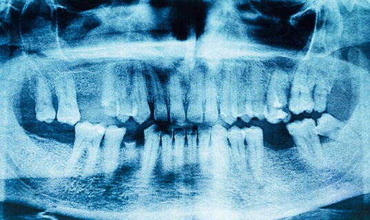 X-ray revealing multiple missing teeth