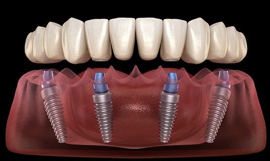 Digital image of implant denture