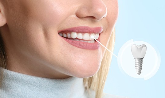 A young woman with a dental implant for a front tooth