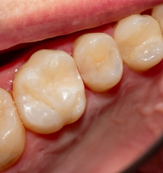 Closeup of smile with tooth colored fillings