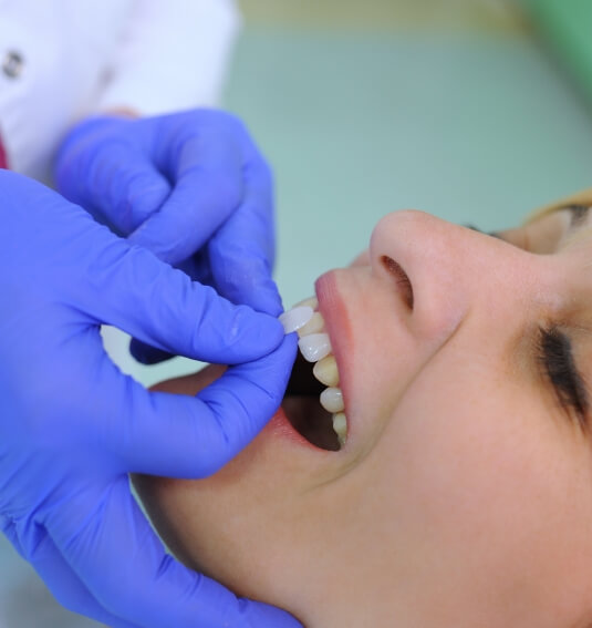 Dentist placing porcelain veneers