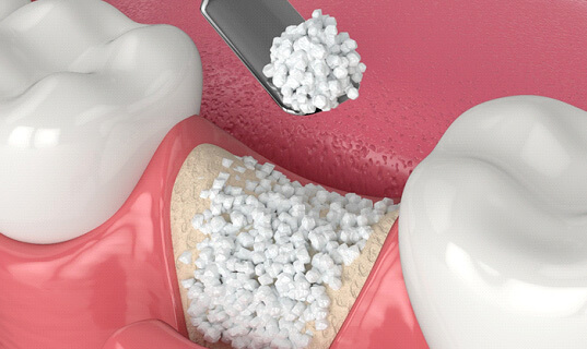 digital illustration of bone graft