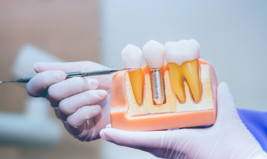 dentist pointing to a dental implant model