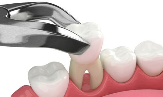Illustration of tooth being extracted with forceps