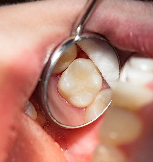 A closeup of a tooth with a tooth-colored filling