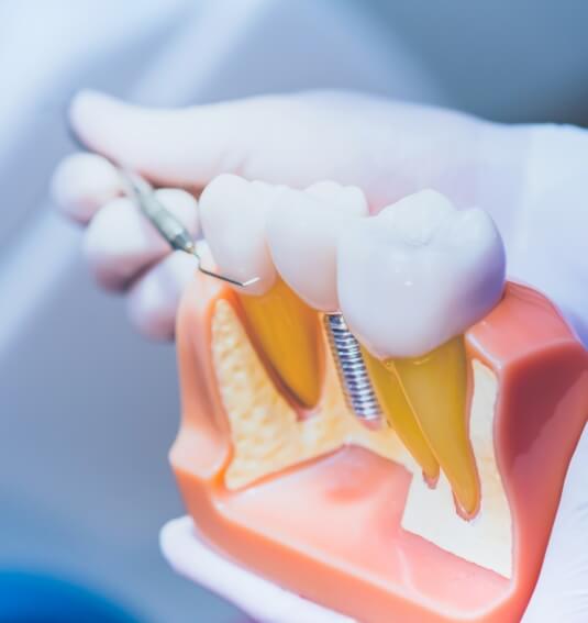 Dentist using model to explain dental implants