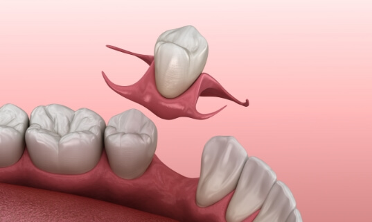 Animated dental implant supported dental crown palcement