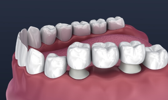 Animated dental implant supported fixed bridge placement