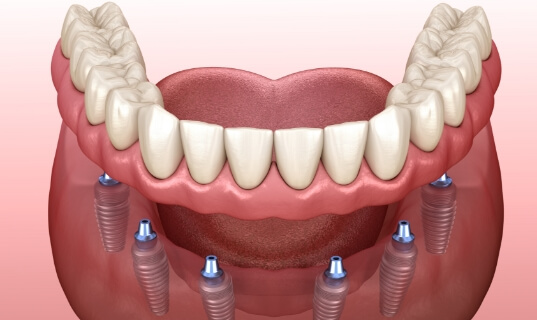 Animated dental implant supported denture placement