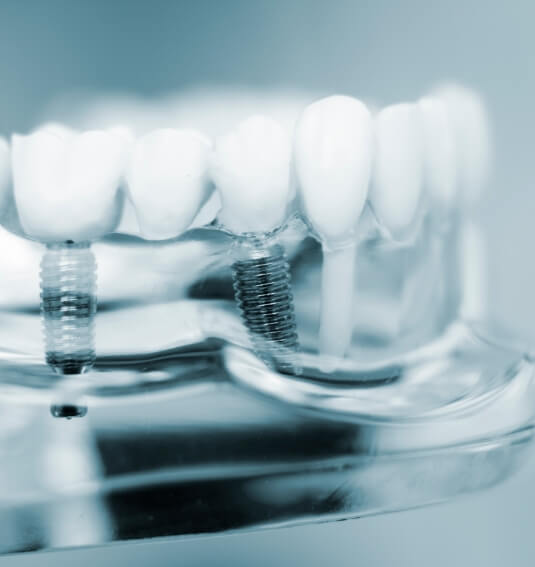 Model of dental implant supported fixed bridge restoration