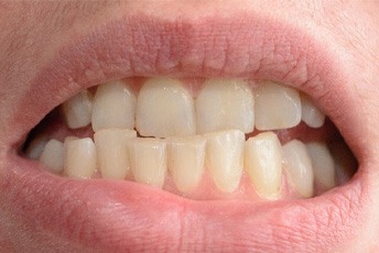 Closeup of a crowded smile