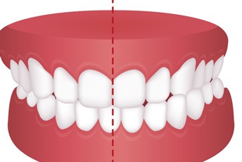 Drawing of a crossbite