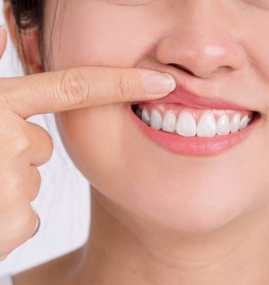 a patient smiling after receiving LANAP surgery