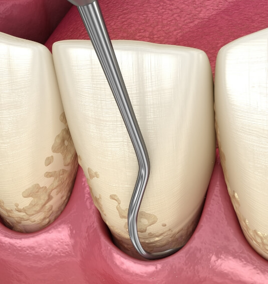 Animated smile during scaling and root planing treatment