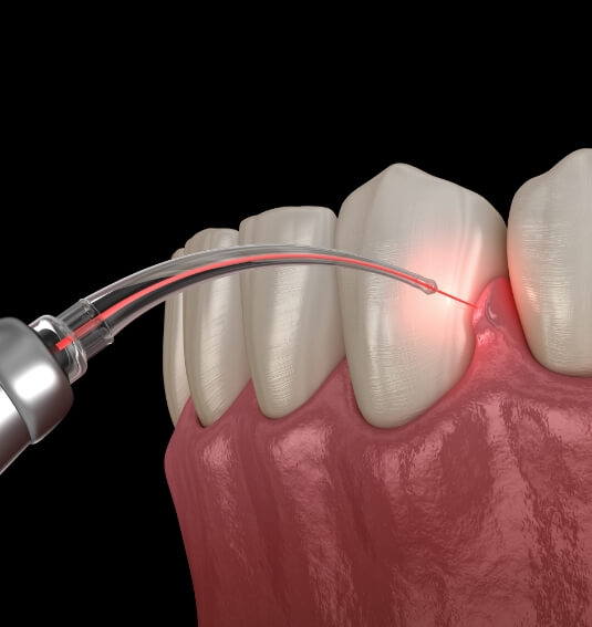 Animated smile during laser periodontal therapy