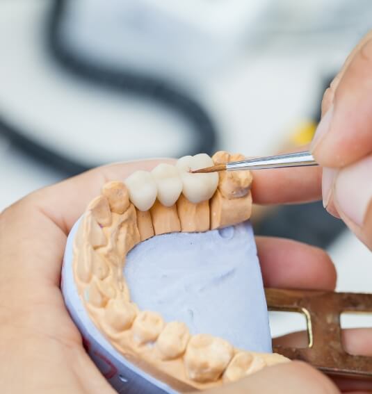 Model smile with a dental bridge restoration