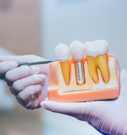 Model comparing dental implant supported dental crown to natural teeth