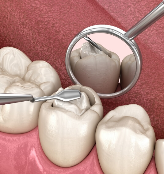 Animated smile during tooth colored filling placement