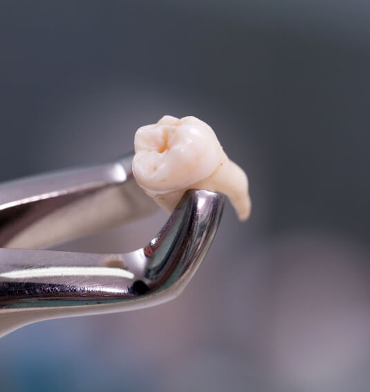 Metal clasp holding a tooth after extraction