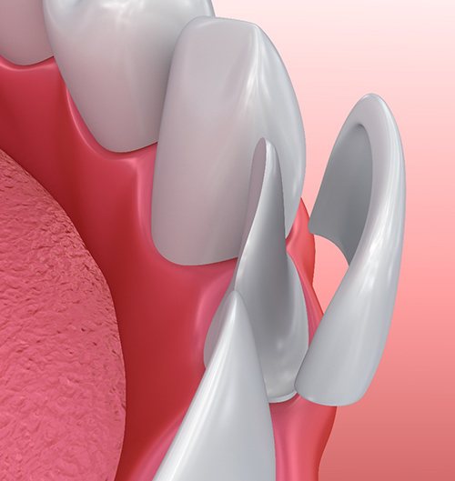 an example of a veneer covering a tooth