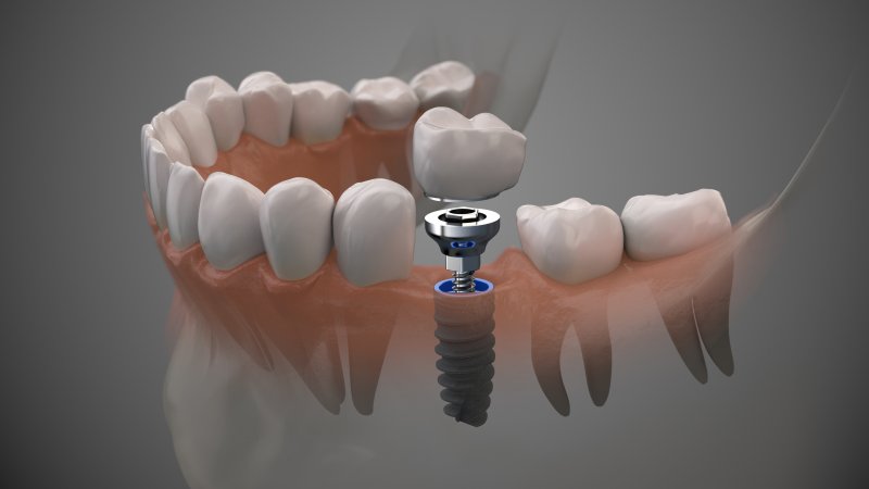 a single dental implant