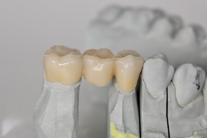 Dental bridge resting on top of a plaster model 